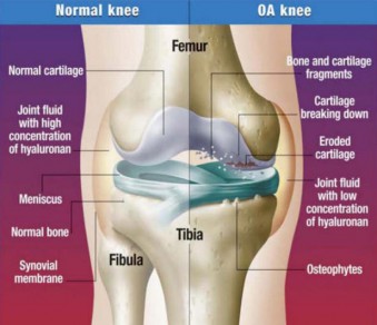 This illustration shows the difference between a normal and osteoarthritic knee.